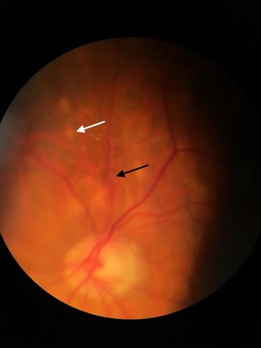 Sarcoid granulomas + retinal macroaneurysm